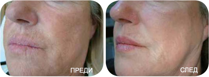 Prophilo преди и след